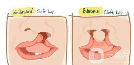 唇腭裂修復(fù)手術(shù)的成因與糾正 我的孩子什么時候應(yīng)該做手術(shù)