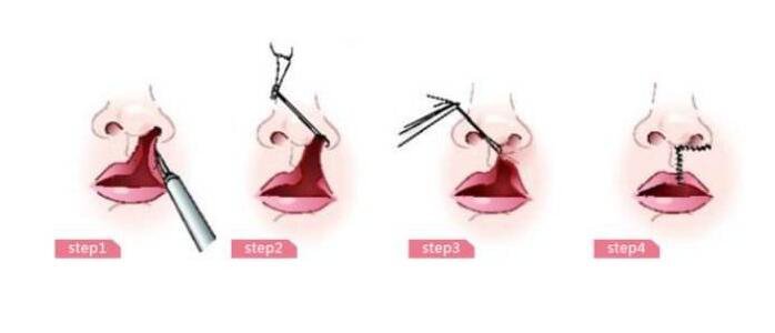 唇腭裂修復(fù)手術(shù)的成因與糾正 我的孩子什么時候應(yīng)該做手術(shù)