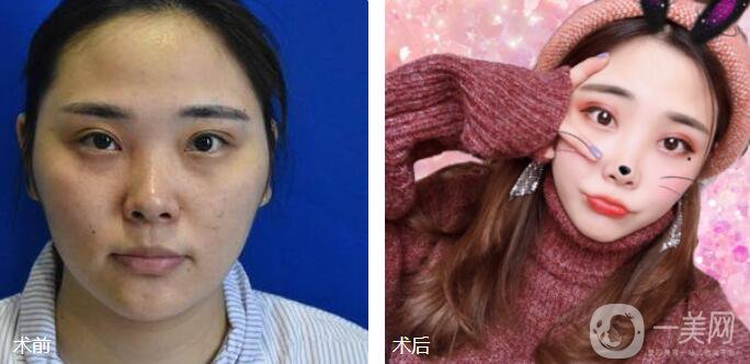 磨顴骨前后照片分享介紹 真人案例 33天就看見*果！