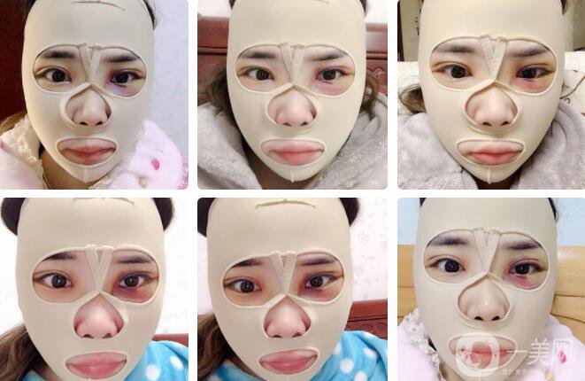 磨顴骨前后照片分享介紹 真人案例 33天就看見*果！