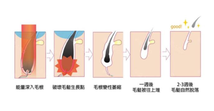 冰點(diǎn)華爾茲脫毛價(jià)格