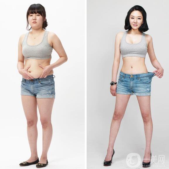 吸脂塑形前后圖