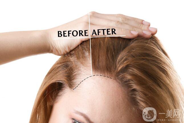 瀘州毛發(fā)移植價(jià)格是多少錢