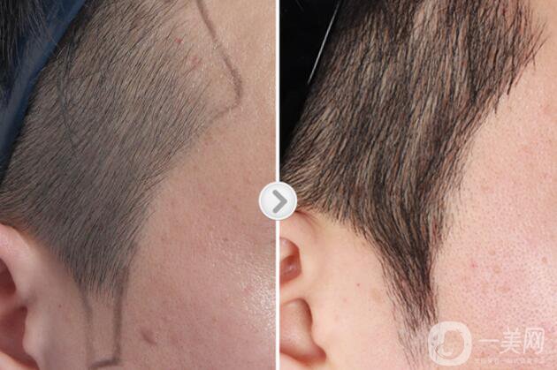 瀘州毛發(fā)移植價(jià)格是多少錢