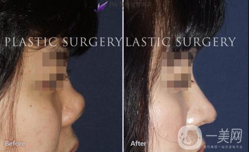 手術(shù)縮鼻翼