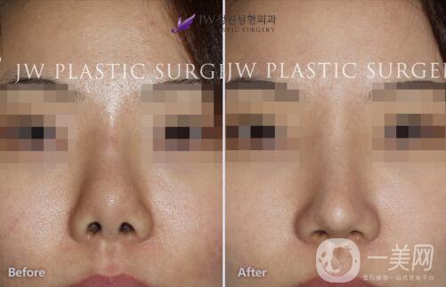 鼻翼縮小術(shù)