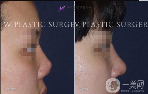 鼻翼縮小術(shù)