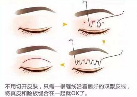 北京埋線雙眼皮修復(fù)價(jià)格盤點(diǎn)