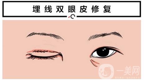 北京埋線雙眼皮修復(fù)價(jià)格盤點(diǎn)