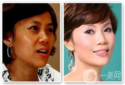 彩光嫩膚*嗎？對(duì)人體有害嗎？