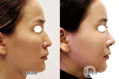 瑞蘭玻尿酸隆鼻價(jià)格多少錢？貴嗎？