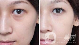 納米脂肪填充淚溝*果如何_圖片