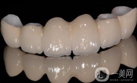 北京烤瓷牙價格及種類詳情?