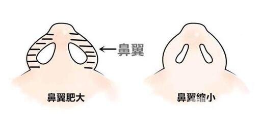 鼻頭鼻翼縮小多久能看到*果?