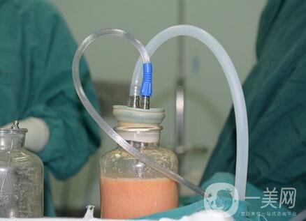 負(fù)壓吸脂*果和水動(dòng)力一樣嗎?哪個(gè)更好?