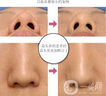 鼻翼縮小手術(shù)恢復(fù)過程