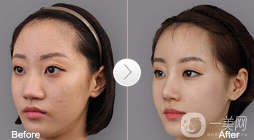 鼻翼縮小手術(shù)恢復(fù)過程