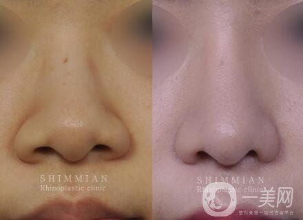 鼻翼縮小手術(shù)恢復(fù)過程