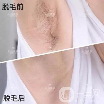 激光脫毛手術(shù)要多少錢一次？