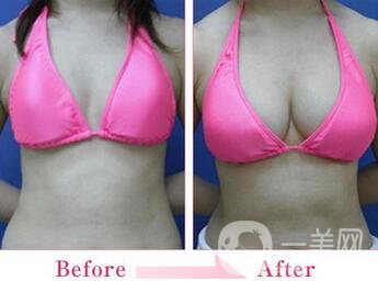 假體隆胸的技術(shù)目前已經(jīng)比較成熟，有些愛美的女士在胸部位置，想要借助假體，來擴(kuò)大胸部的*果。 為了讓自己能夠突出獨(dú)特象征的身材，想到的方法就是選擇進(jìn)行假體隆胸手術(shù)，通過做假體隆胸手術(shù)，可以讓我們擁有傲人的身姿。毛面隆胸假體外層有組紋，有種磨砂的手感，它的其在特點(diǎn)是可允許組織粘在表面，這樣*降低包膜縮小的可能，其中相對價格比其他的貴一些。