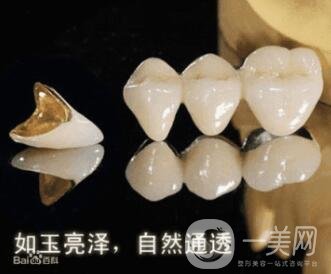 烤瓷牙的種類和優(yōu)缺點(diǎn)分別是什么呢？