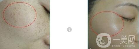 光子嫩膚適合人群有哪些?