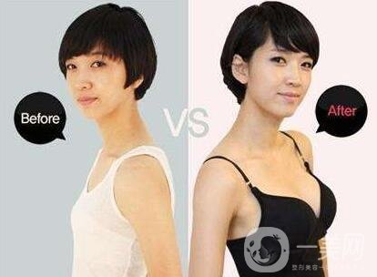 麥格假體隆胸多少錢(qián)?費(fèi)用貴嗎?