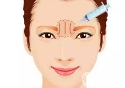 玻尿酸去眉間紋