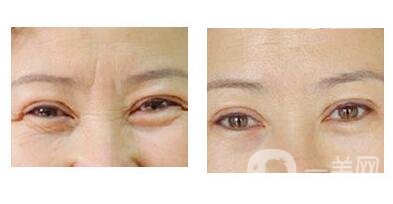 玻尿酸去眉間紋