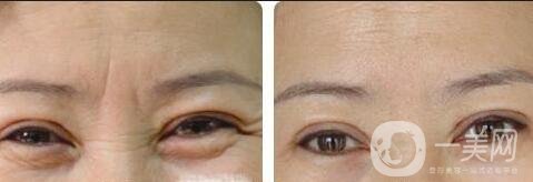 玻尿酸去眉間紋