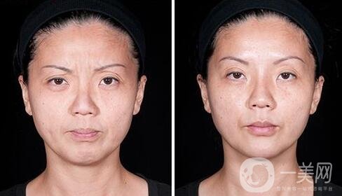 玻尿酸去眉間紋