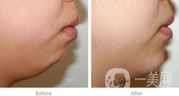 硅膠墊下巴排異癥狀有哪些？怎樣才知道排異了？