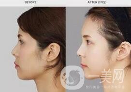 硅膠墊下巴要疼幾天？如何緩解這種疼痛感？