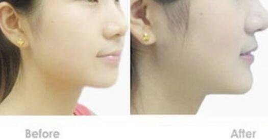 硅膠墊下巴硬得像石頭，多久能恢復(fù)？