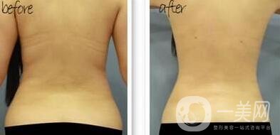 后背吸脂1000毫升多嗎？有*的瘦背*果嗎？