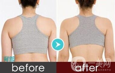 后背吸脂1000毫升多嗎？有*的瘦背*果嗎？