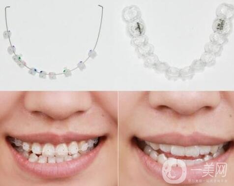 3m半隱形牙套價(jià)格多少錢(qián)?貴嗎?