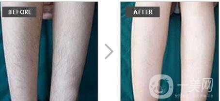 IPL光子脫毛有副作用嗎?要做的bb有必要了解下