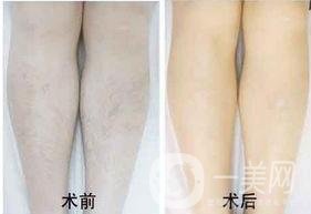 IPL光子脫毛有副作用嗎?要做的bb有必要了解下