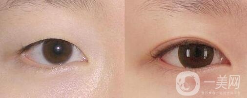 阿爾法美眼術(shù)過程是怎么做的?