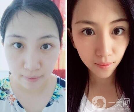 阿爾法美眼術(shù)過程是怎么做的?