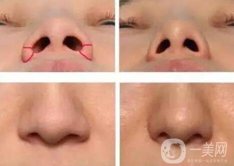 鼻孔太大了怎么變小一點(diǎn)?