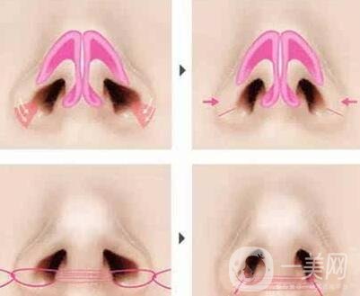 鼻孔太大了怎么變小一點(diǎn)?