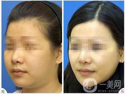 雙下巴吸脂不戴頭套有什么后果?