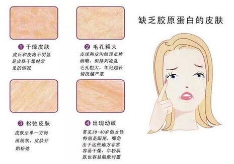 填充膠原蛋白發(fā)硬凸起應(yīng)該怎么辦?