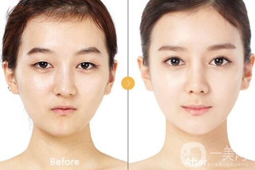 玻尿酸豐太陽穴