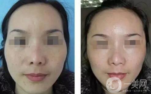 玻尿酸豐太陽穴