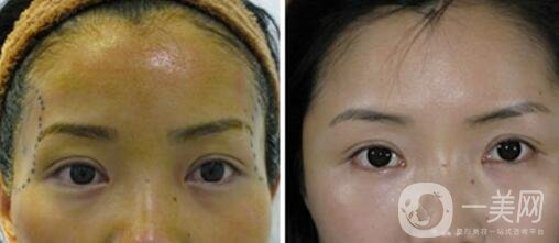 玻尿酸豐太陽穴