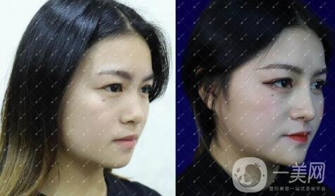 鼻整形修復(fù)手術(shù)