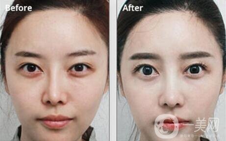 鼻整形修復(fù)手術(shù)